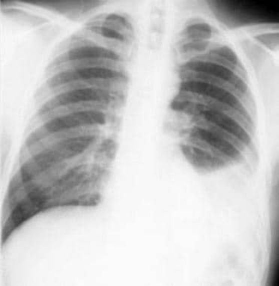 世界无烟日：触目惊心！浓烟下的肺原来长这样！