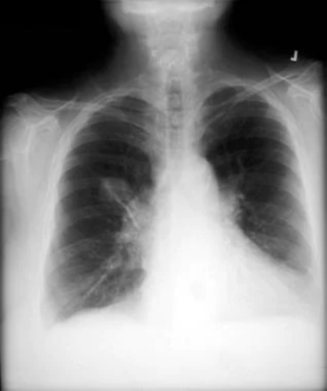 世界无烟日：触目惊心！浓烟下的肺原来长这样！