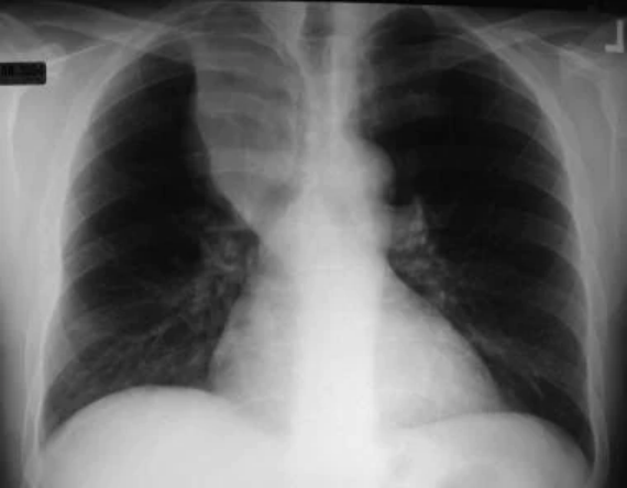 世界无烟日：触目惊心！浓烟下的肺原来长这样！