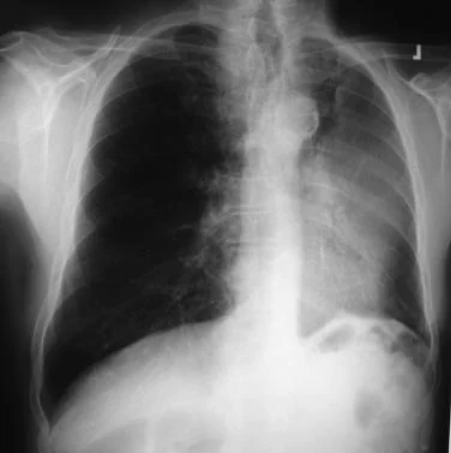 世界无烟日：触目惊心！浓烟下的肺原来长这样！