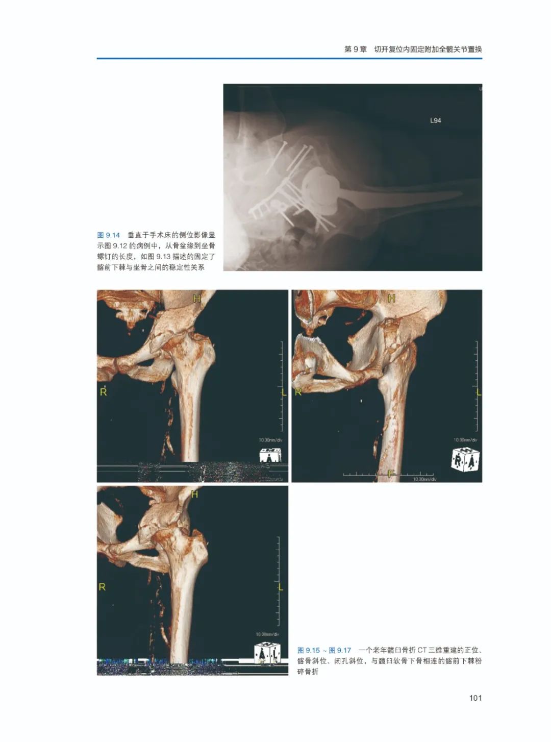 预售！这本书教你判定老年髋臼骨折手术的治疗及适应证！