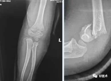 临床必备：儿童肱骨髁上骨折，复位方法及经皮穿针技巧详解！