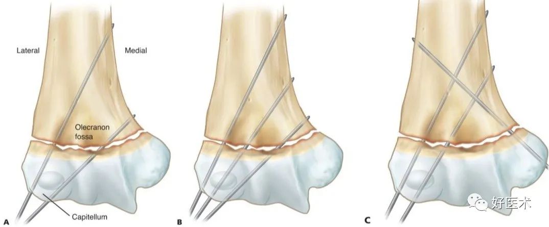 临床必备：儿童肱骨髁上骨折，复位方法及经皮穿针技巧详解！