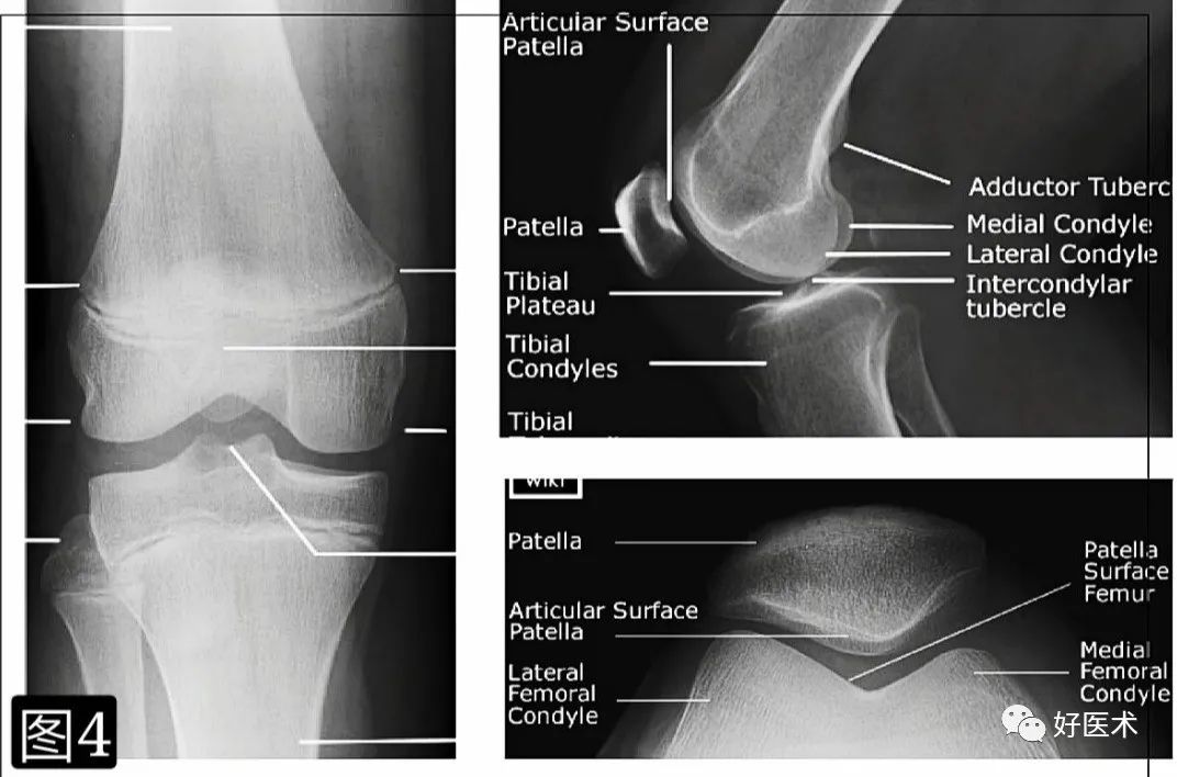 髌骨软化：青壮年最常见膝盖痛，99%的人都误解了！