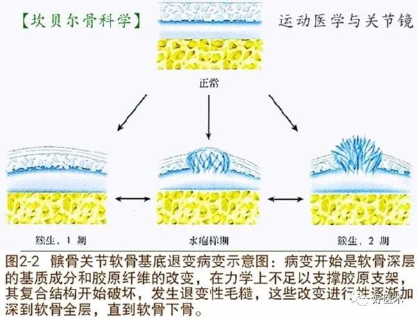 髌骨软化：青壮年最常见膝盖痛，99%的人都误解了！