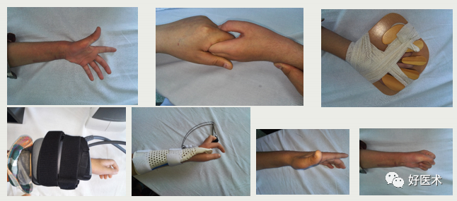 手部外伤术后康复方案及技巧，一次性讲清楚！