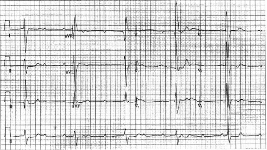 致命性心律失常的心电图你会判读吗？