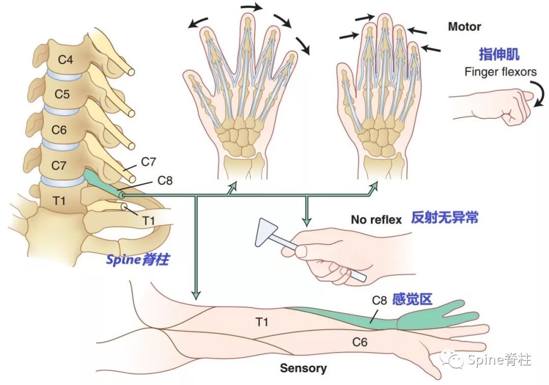 手麻、颈痛？一文读懂最常见的神经根型颈椎病！