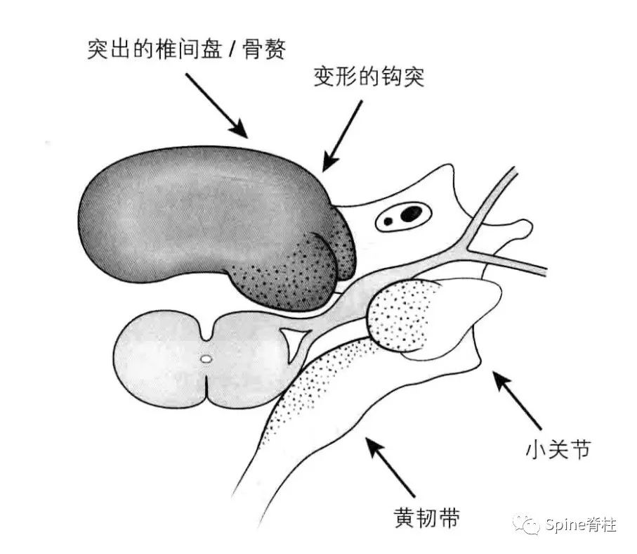 手麻、颈痛？一文读懂最常见的神经根型颈椎病！