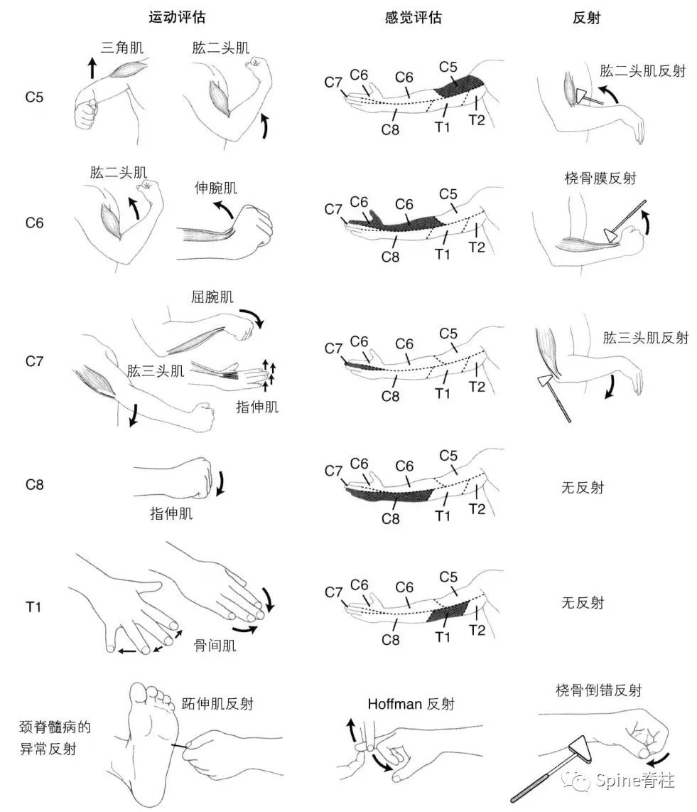 手麻、颈痛？一文读懂最常见的神经根型颈椎病！