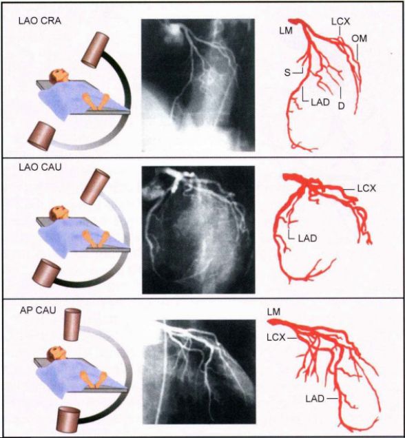 如何看懂冠脉造影图图片