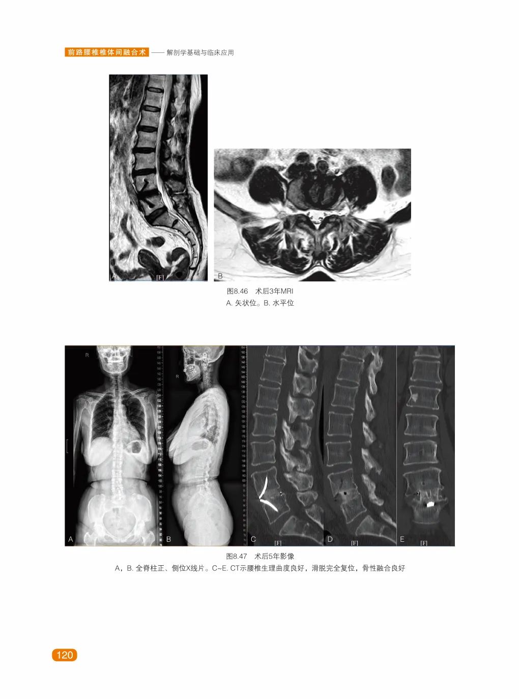 新书首发｜前路腰椎椎体间融合术——解剖学基础与临床应用
