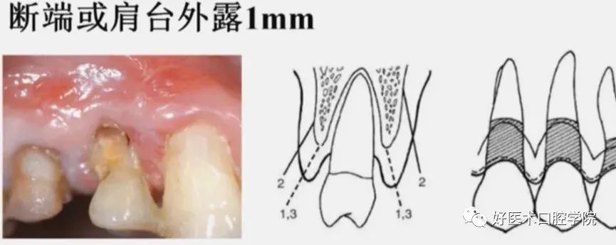 冠延长手术如何做，看完这篇手术思路更清晰！