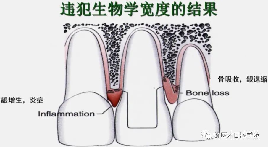 冠延长手术如何做，看完这篇手术思路更清晰！