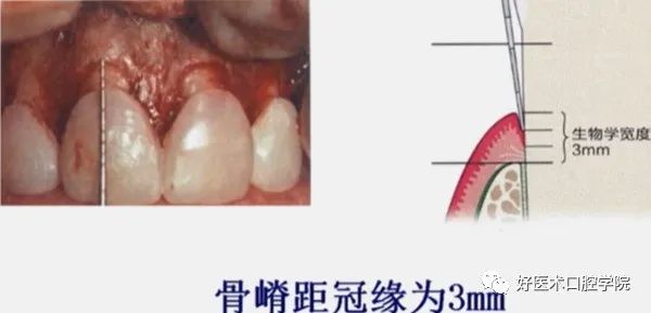 冠延长手术如何做，看完这篇手术思路更清晰！