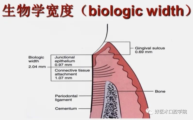 冠延长手术如何做，看完这篇手术思路更清晰！