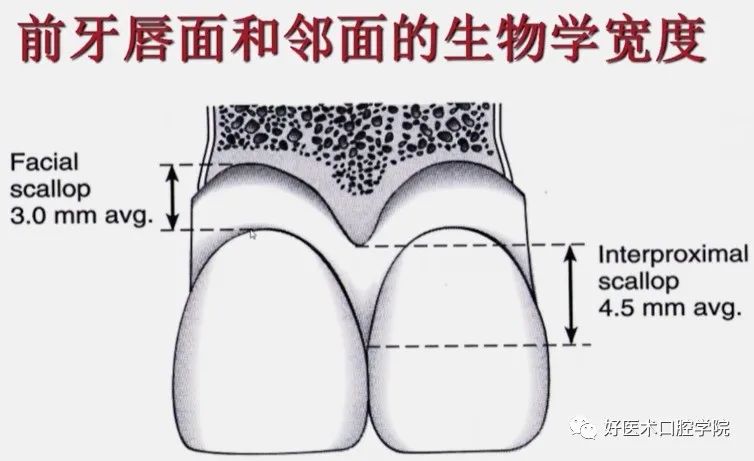 冠延长手术如何做，看完这篇手术思路更清晰！