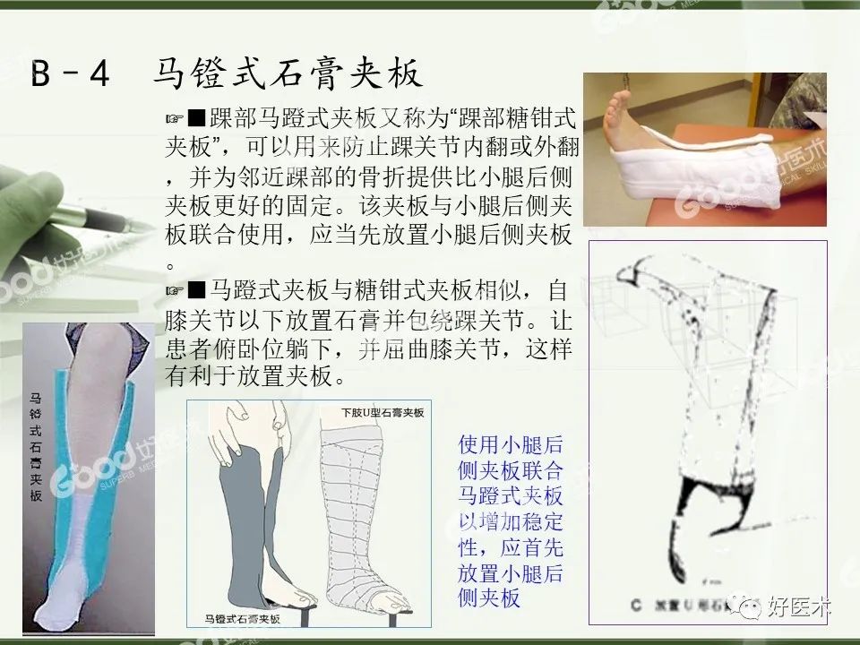 骨科必备：石膏绷带与夹板固定，图文示教超清晰！