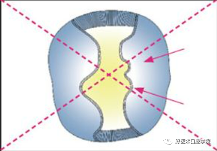 牢记这些嵌体制备要点，可以帮你做好嵌体修复！