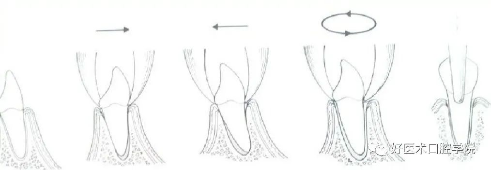 一文帮你记住各类牙拔除方法，提升拔牙技术！