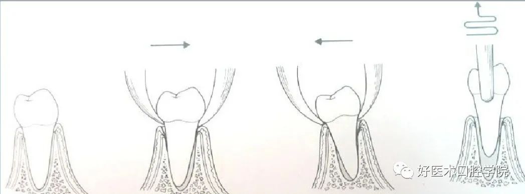 一文帮你记住各类牙拔除方法，提升拔牙技术！