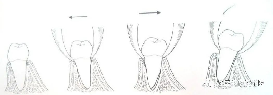 一文帮你记住各类牙拔除方法，提升拔牙技术！