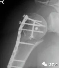 肱骨外科颈骨折，治疗要点手术方法全解！