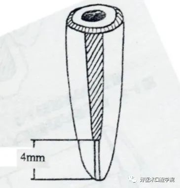 一文概括桩核冠修复的难点重点，帮你提升修复技术！