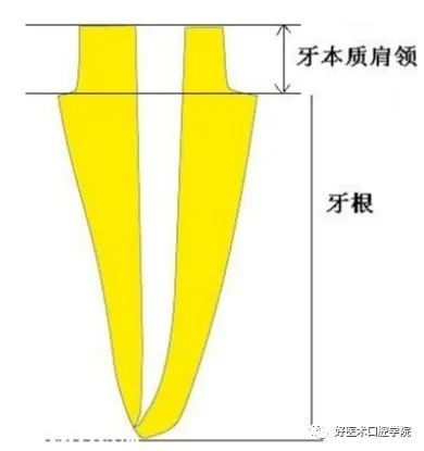 一文概括桩核冠修复的难点重点，帮你提升修复技术！