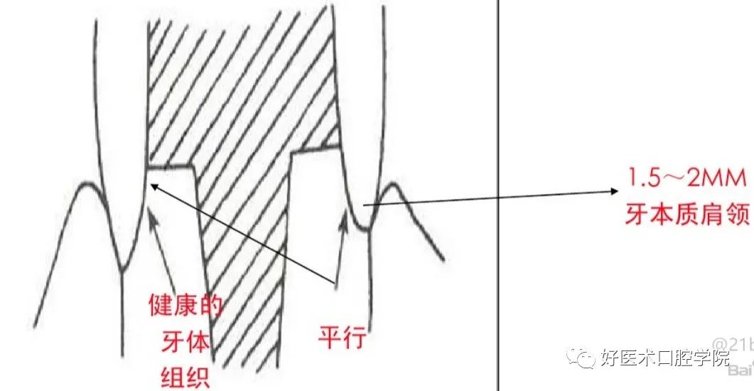 一文概括桩核冠修复的难点重点，帮你提升修复技术！