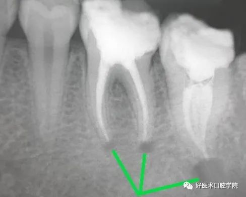 一文概括桩核冠修复的难点重点，帮你提升修复技术！