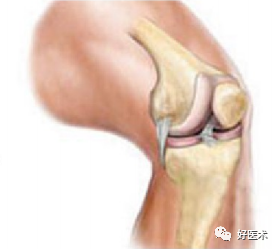 膝关节为什么有积液，一定要抽出来吗？