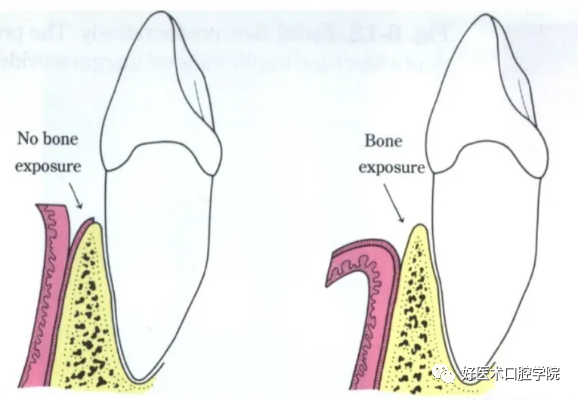牙周翻瓣术图文讲解，你想知道的这里都有！