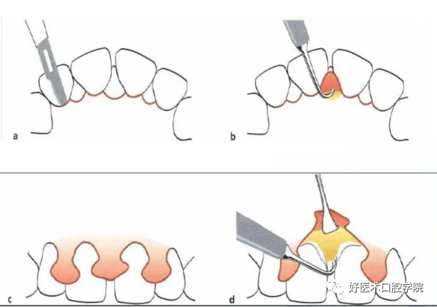 牙周翻瓣术图文讲解，你想知道的这里都有！