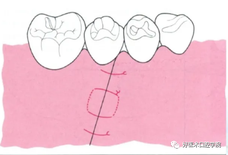 牙周翻瓣术图文讲解，你想知道的这里都有！