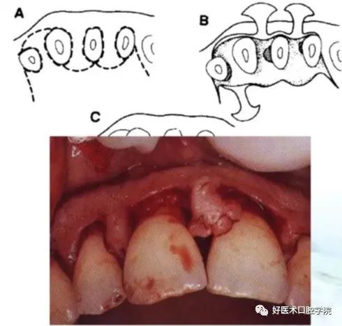 牙周翻瓣术图文讲解，你想知道的这里都有！