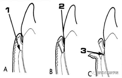 牙周翻瓣术图文讲解，你想知道的这里都有！