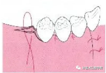 牙周翻瓣术图文讲解，你想知道的这里都有！