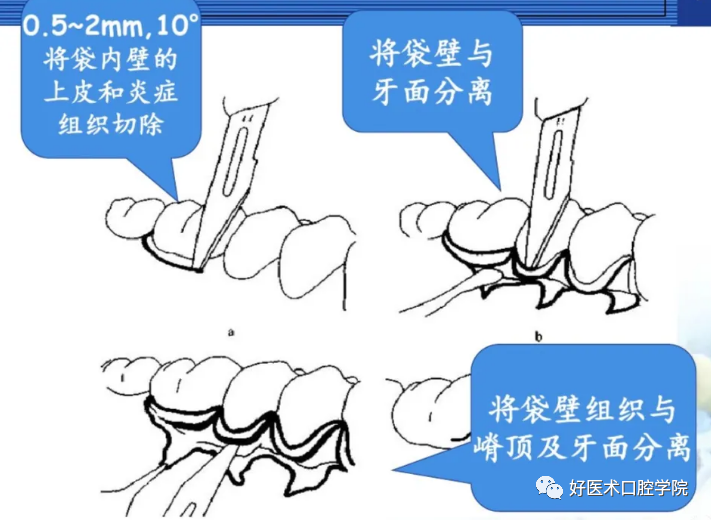 牙周翻瓣术图文讲解，你想知道的这里都有！