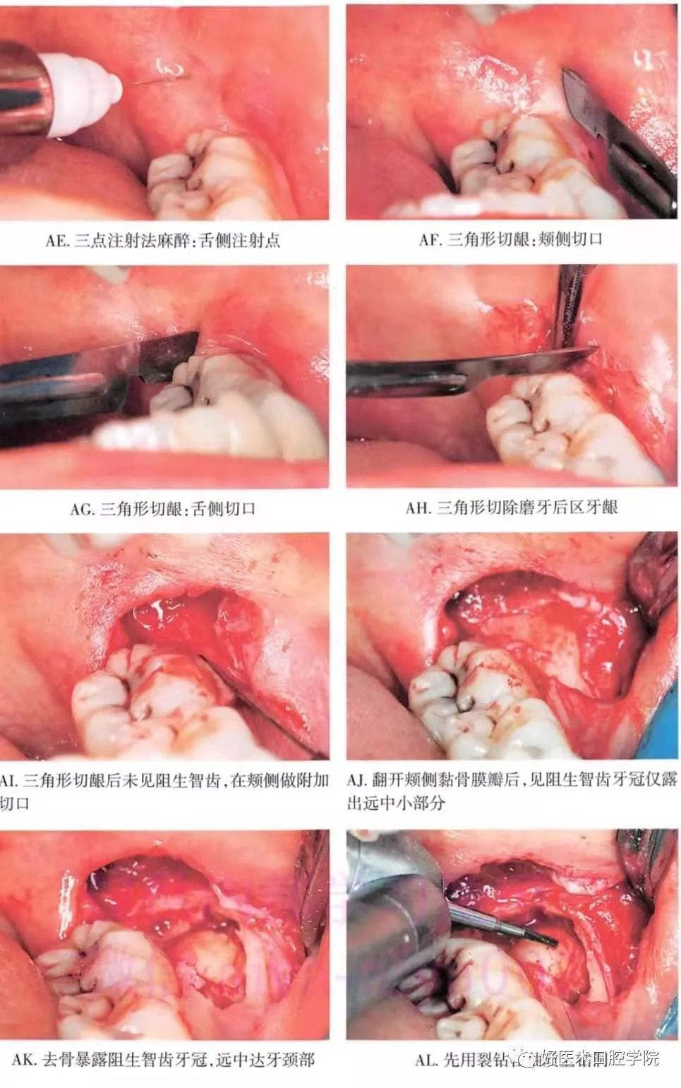 一文说明下颌阻生智齿拔除术，阻力分析是关键！