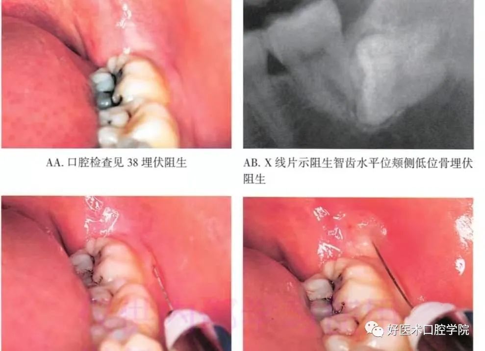一文说明下颌阻生智齿拔除术，阻力分析是关键！