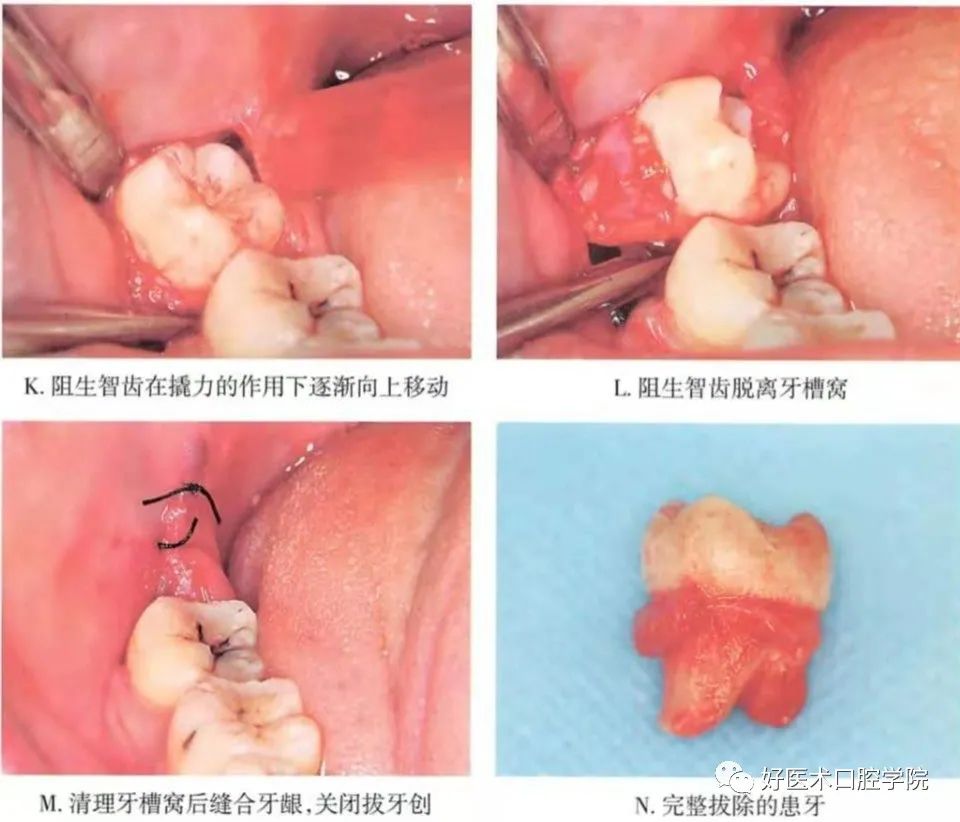 一文说明下颌阻生智齿拔除术，阻力分析是关键！
