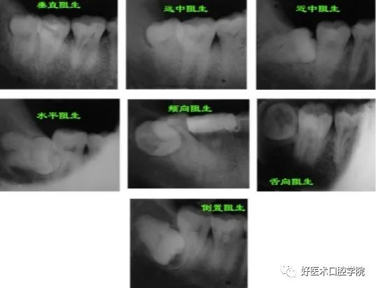 一文说明下颌阻生智齿拔除术，阻力分析是关键！