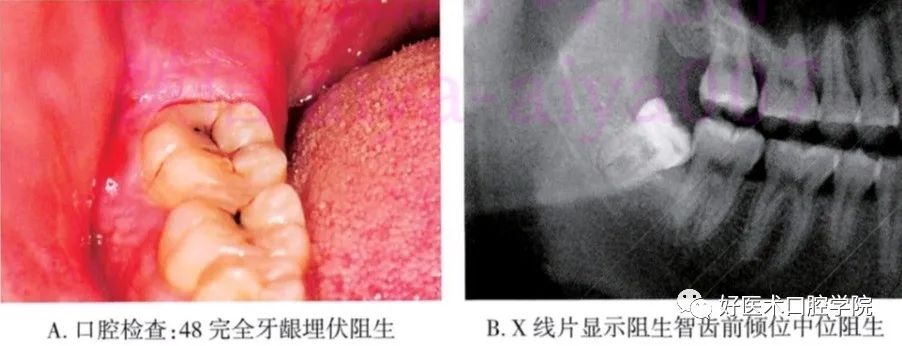一文说明下颌阻生智齿拔除术，阻力分析是关键！