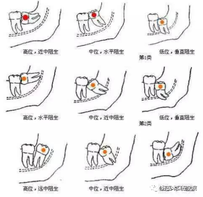 一文说明下颌阻生智齿拔除术，阻力分析是关键！