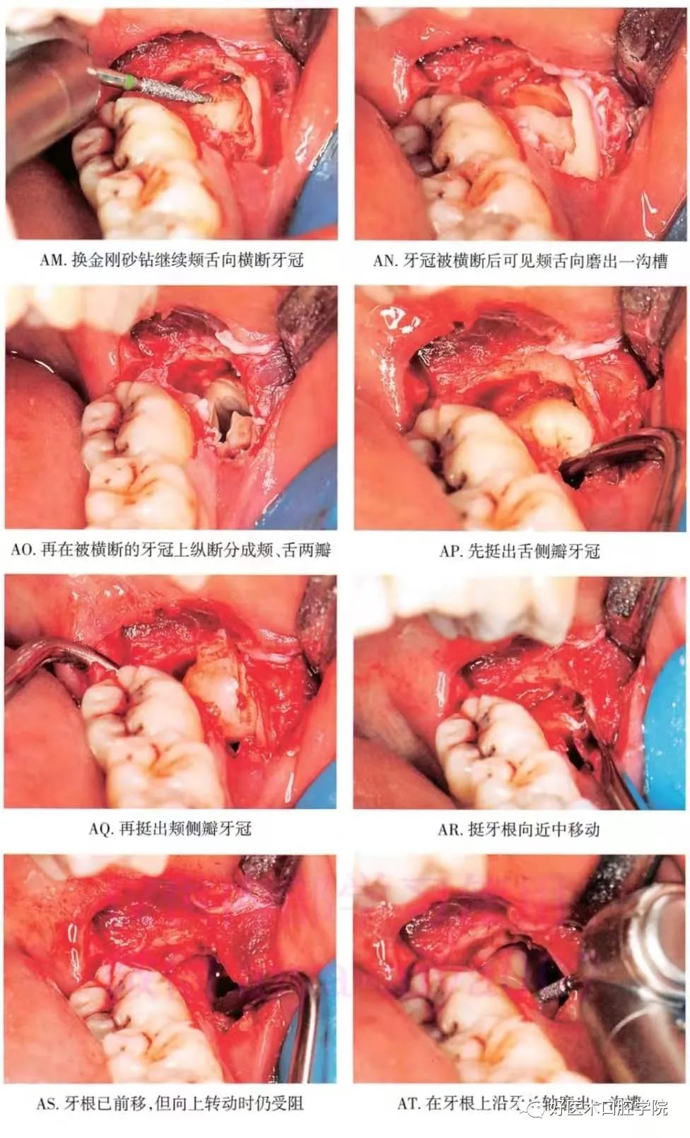 一文说明下颌阻生智齿拔除术，阻力分析是关键！