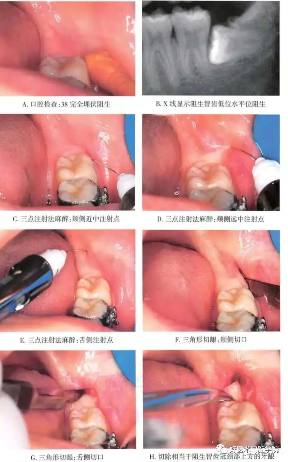一文说明下颌阻生智齿拔除术，阻力分析是关键！