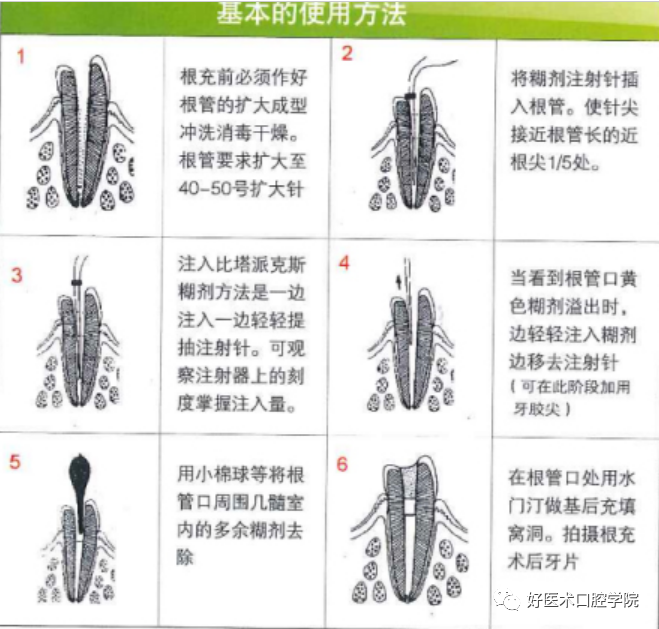 一文解读：乳牙根管治疗，适应症选择很重要!