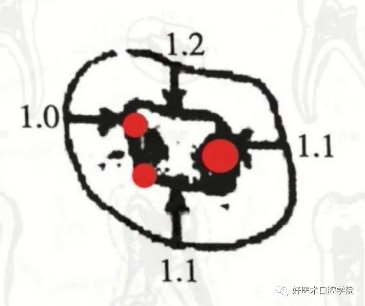 一文解读：乳牙根管治疗，适应症选择很重要!