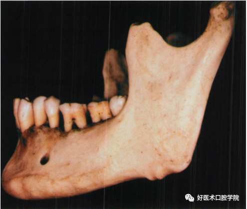 下颌骨解剖应用与种植的关联性，请口腔医生查阅验收！